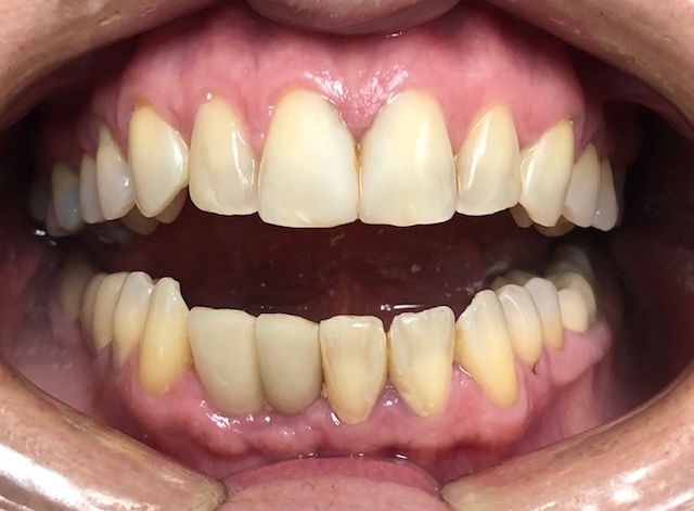 After Implants