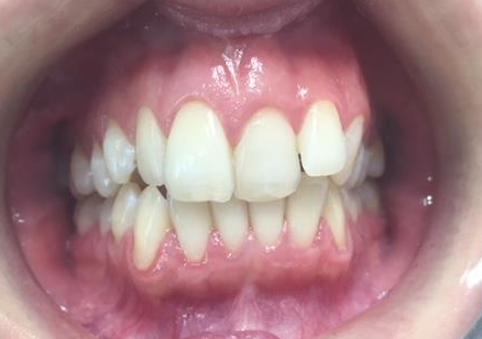 After Whitening