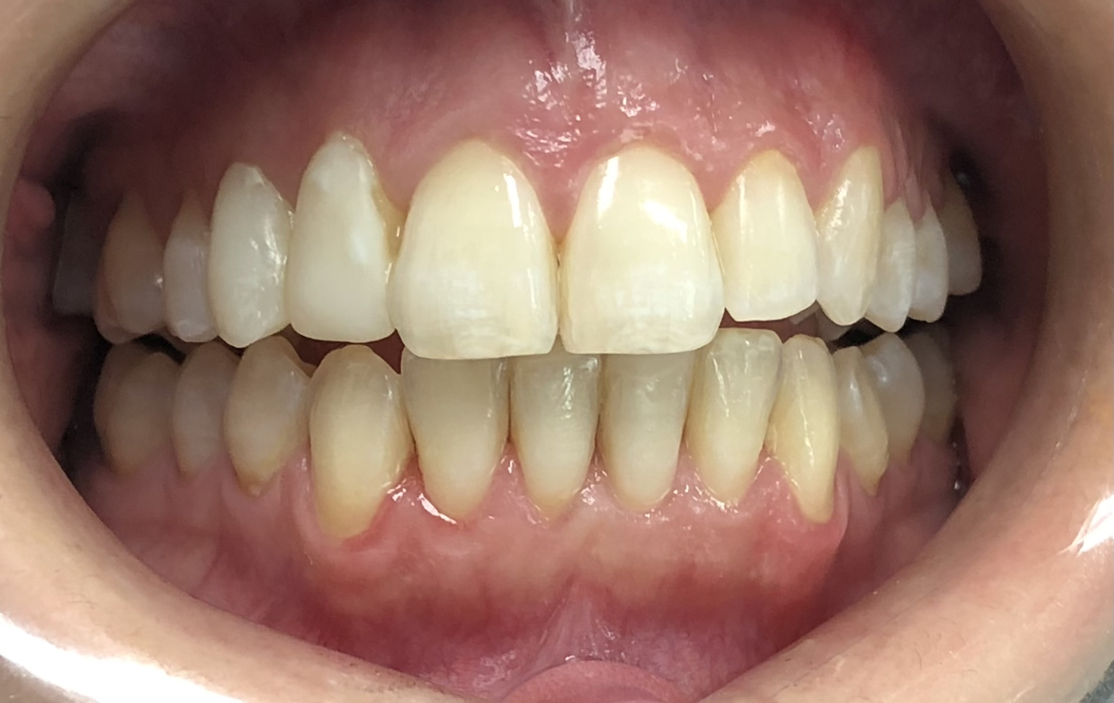 Before Whitening